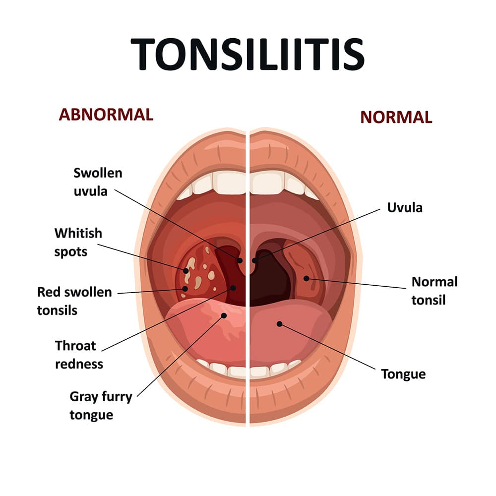 Visual representation of sinus inflammation affecting the nasal and facial sinuses