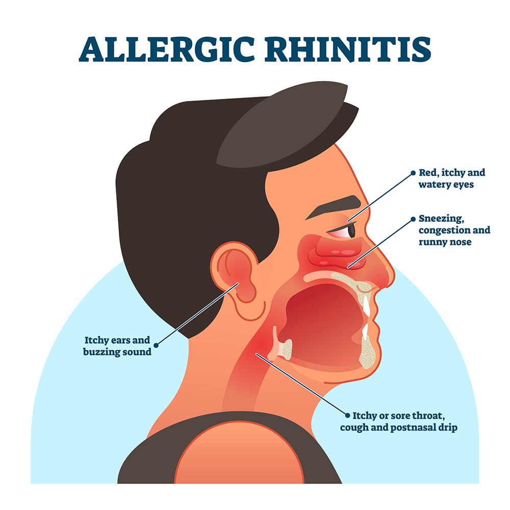 Diagram illustrating allergic rhinitis symptoms, including nasal congestion and post-nasal drip