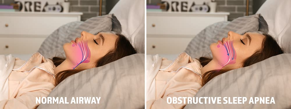 An image illustrating blocked airways in sleep apnea